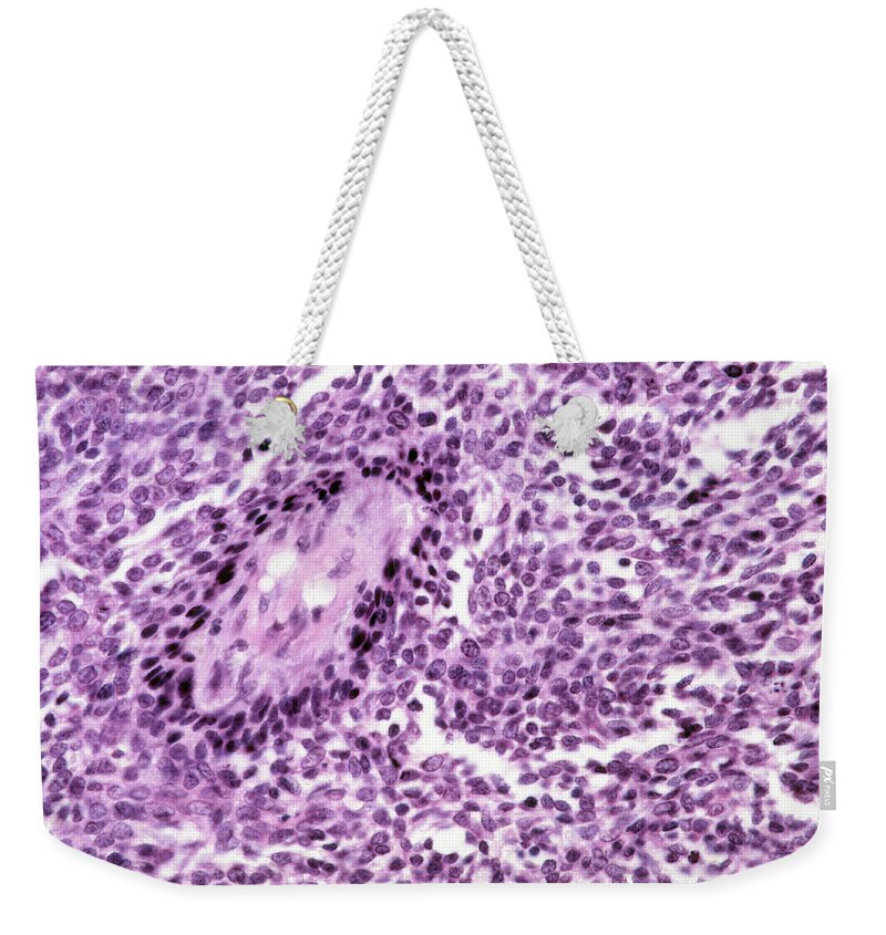 Anatomy Weekender Tote Bag featuring the photograph Basal-cell Carcinoma, Lm #3 by Michael Abbey