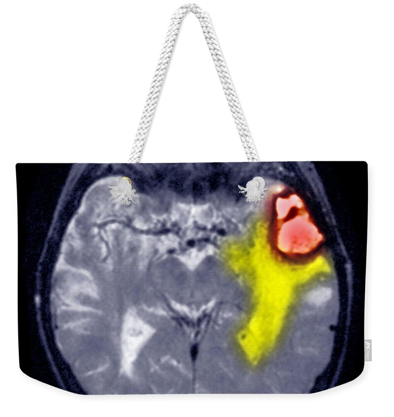 Mri Weekender Tote Bag featuring the photograph Mri Scan Of A Brain Hemorrhage #3 by Scott Camazine