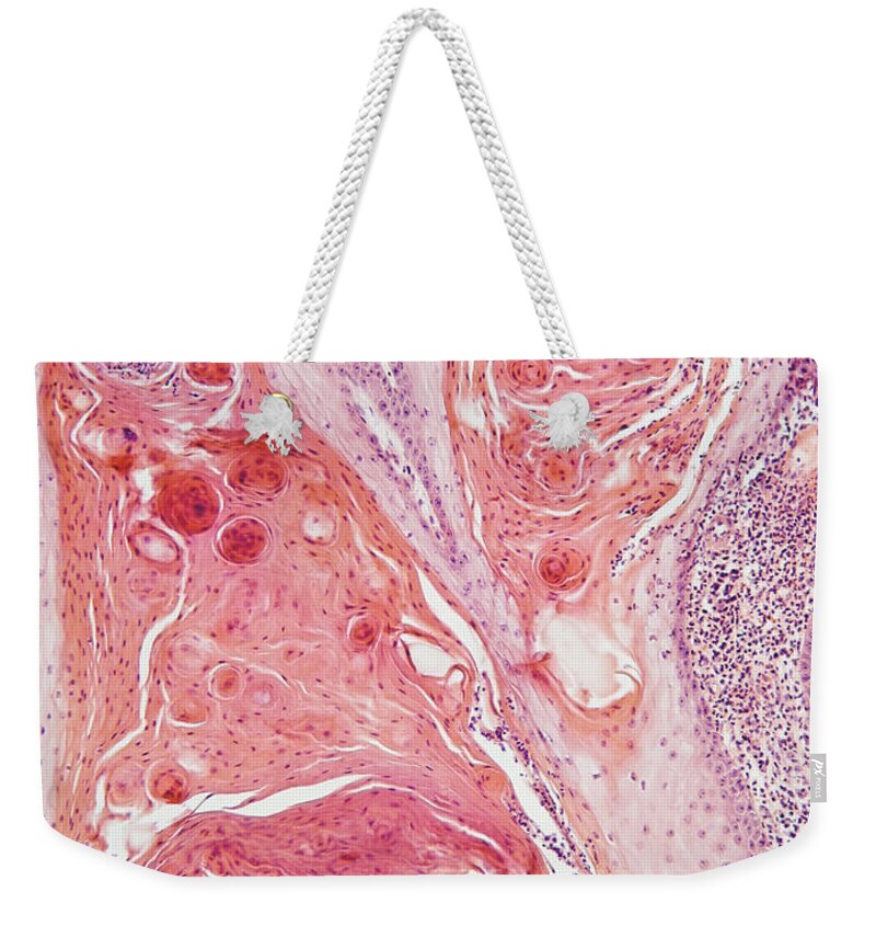 Nucleus Weekender Tote Bag featuring the photograph Anal Squamous Cell Carcinoma, Lm by Garry DeLong