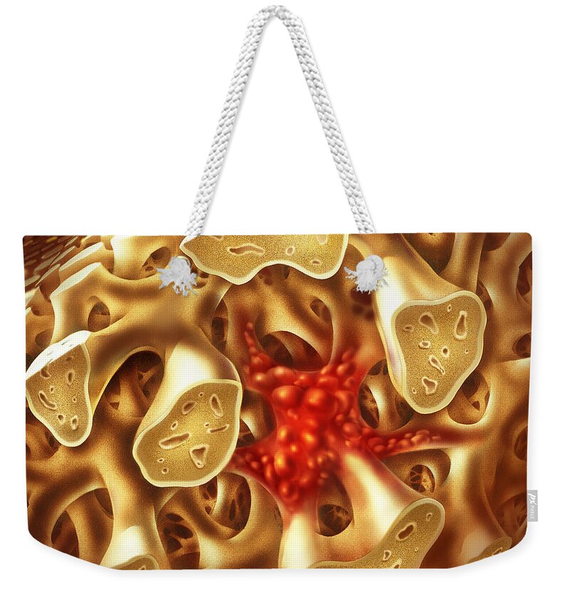 Bone Cancer Weekender Tote Bag featuring the photograph Bone Cancer by Jim Dowdalls