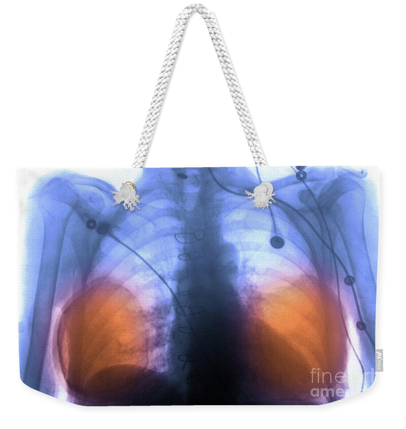Implant Weekender Tote Bag featuring the photograph Breast Implants by Scott Camazine