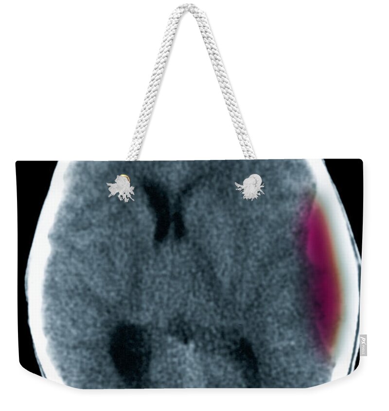 Ct Scan Weekender Tote Bag featuring the photograph Cerebral Ct Showing Subdural Hematoma by Scott Camazine