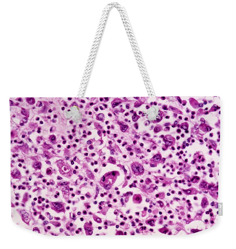 Abnormal Weekender Tote Bag featuring the photograph Giant-cell Carcinoma Of The Lung, Lm by Michael Abbey