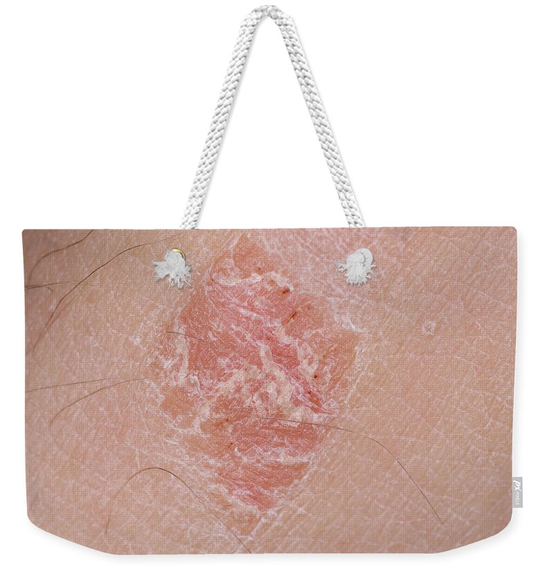 Auto Immune Weekender Tote Bag featuring the photograph Plaque Psoriasis On Leg by Martin Shields