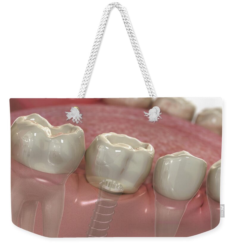 Square Image Weekender Tote Bag featuring the photograph Tooth Implant Lower Jaw by Science Picture Co