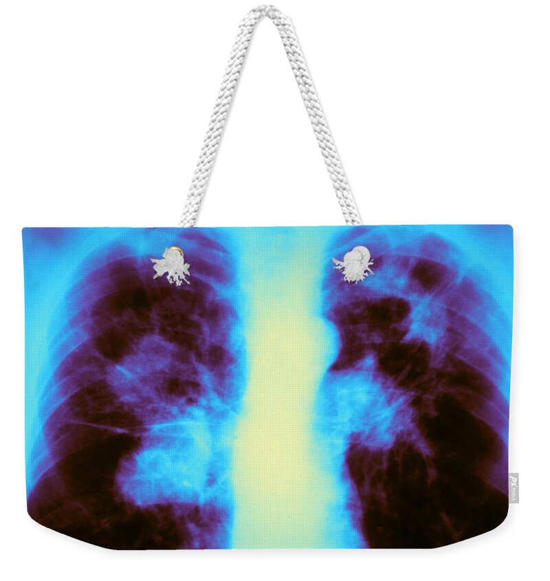 Abnormal Weekender Tote Bag featuring the photograph Tuberculosis Infection by Michael Abbey