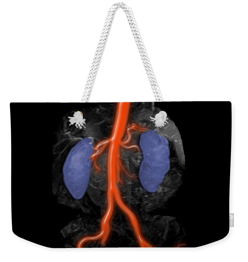 Medical Weekender Tote Bag featuring the photograph Abdominal Aorta, Kidneys And Iliac #1 by Medical Body Scans