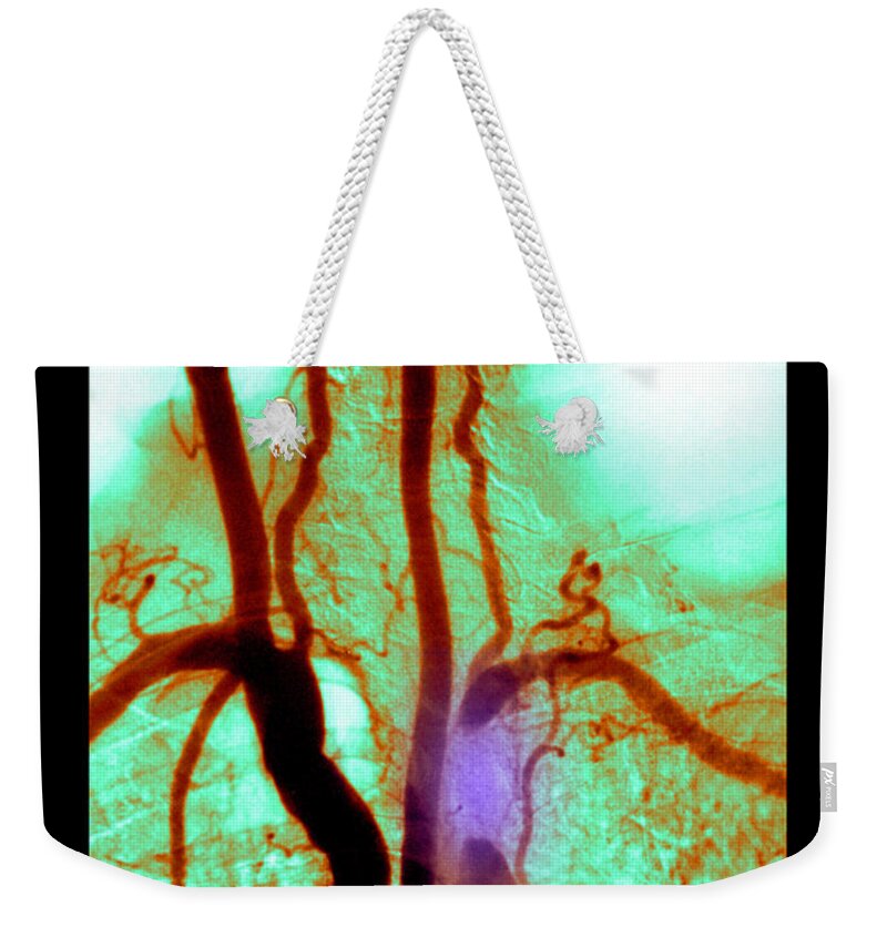 Abnormal Angiogram Weekender Tote Bag featuring the photograph Aortic Arch Angiogram #1 by Medical Body Scans