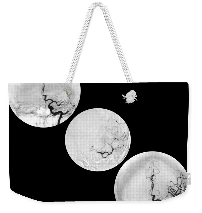 Angiogram Of Stroke Weekender Tote Bag featuring the photograph Stroke Treatment by Medical Body Scans
