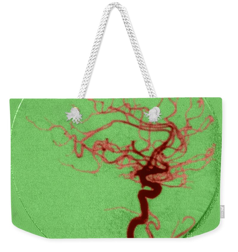 Angiogram Weekender Tote Bag featuring the photograph Cerebral Angiogram #3 by Science Source