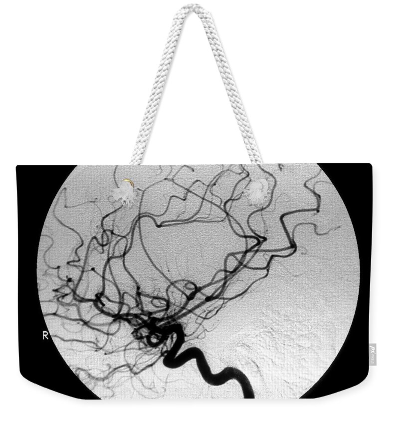 Cerebral Angiogram Weekender Tote Bag featuring the photograph Internal Carotid Cerebral Angiogram #3 by Medical Body Scans