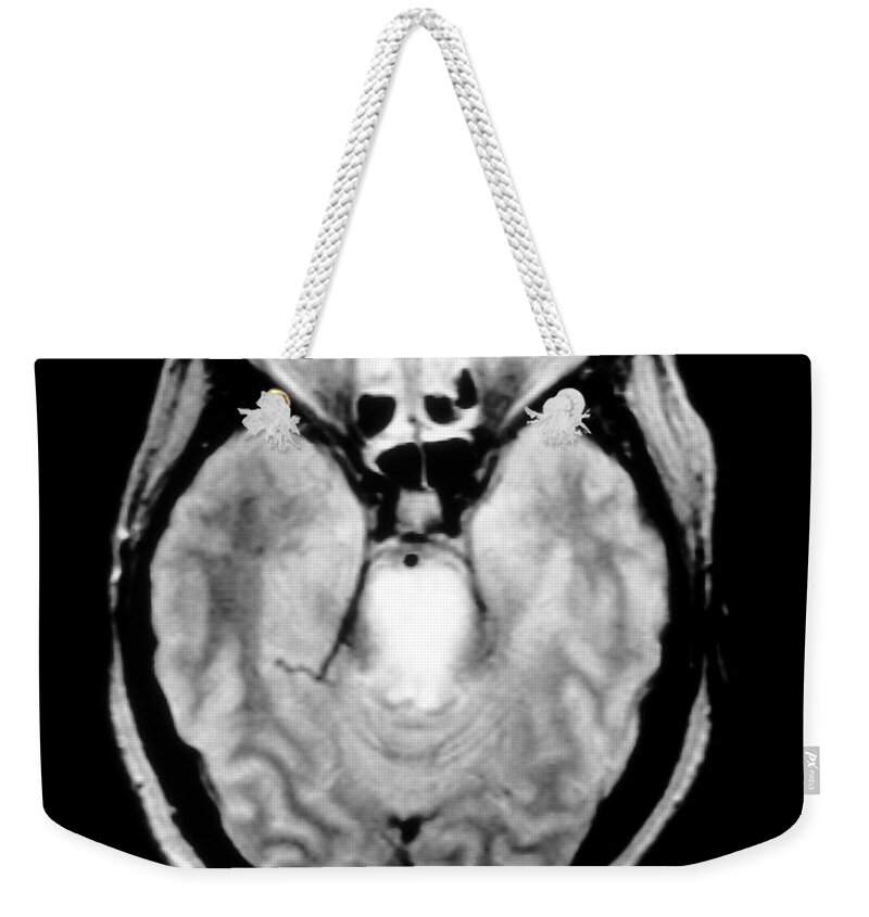 Mri Of Brain Tumor Weekender Tote Bag featuring the photograph Mri Of Brainstem Glioma #3 by Medical Body Scans