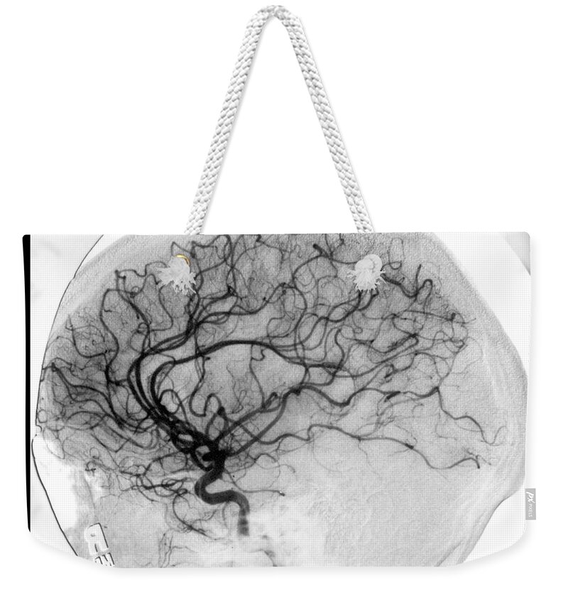 Catheter Cerebral Angiogram Weekender Tote Bag featuring the photograph Cerebral Angiogram #8 by Medical Body Scans