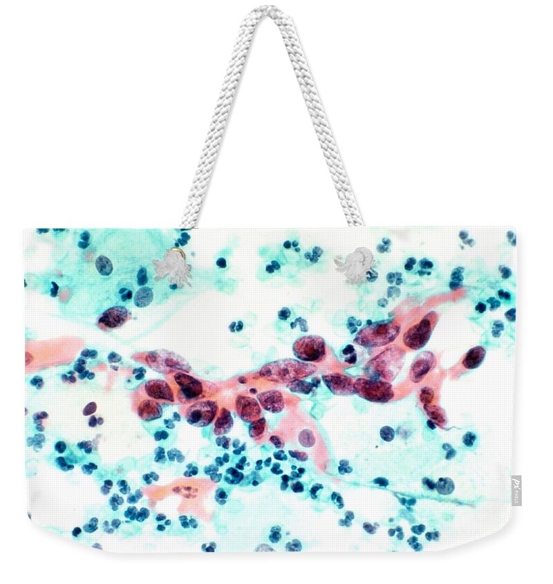 Cervical Cancer Weekender Tote Bag featuring the photograph Cervical Cancer by Science Source