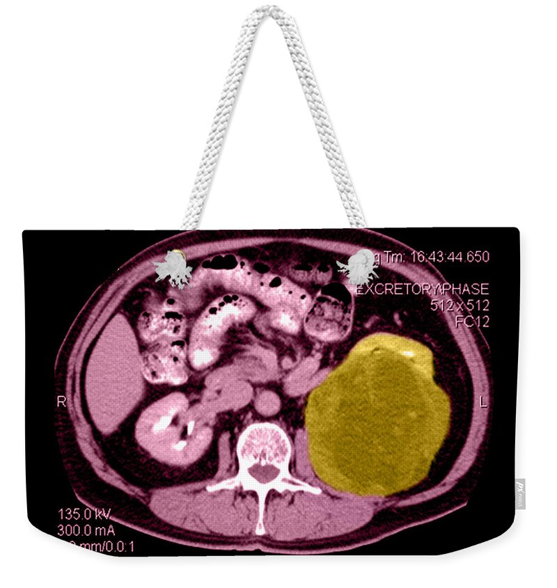 Abnormal Ct Of Abdomen Weekender Tote Bag featuring the photograph Ct Of Abdomen, Large Renal Carcinoma by Medical Body Scans