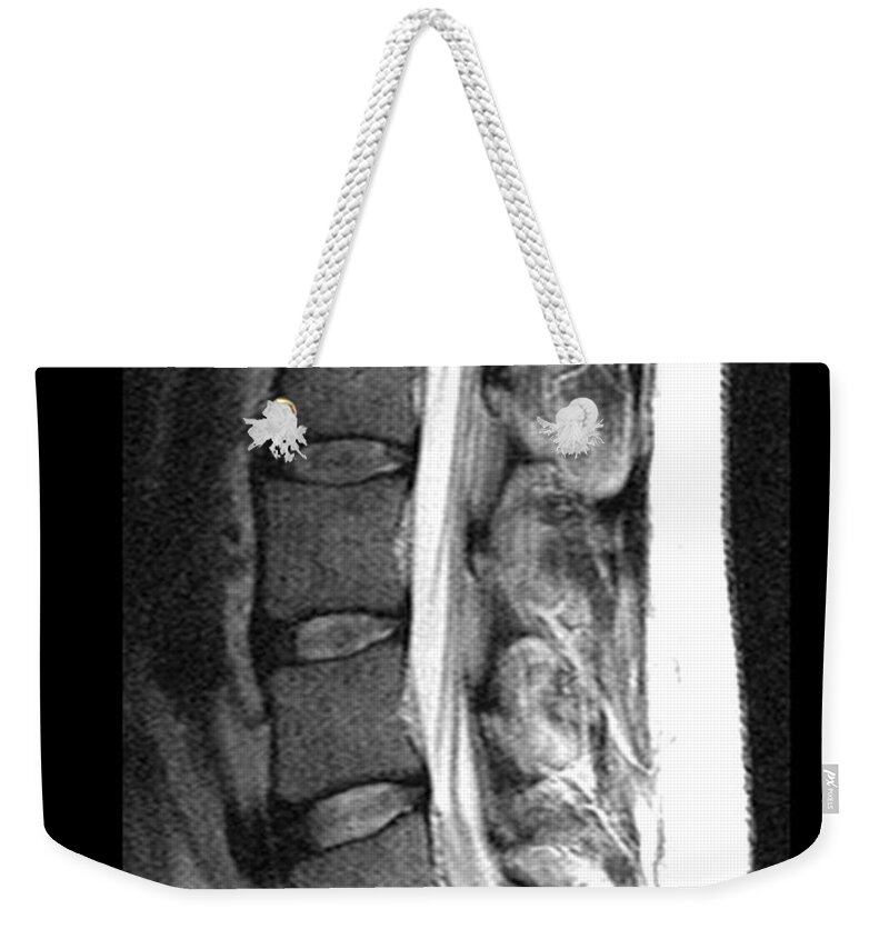 Mri Weekender Tote Bag featuring the photograph Herniated Disc by Medical Body Scans