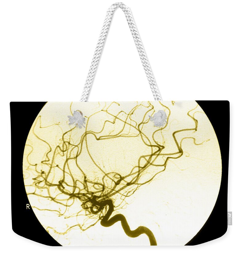 Cerebral Angiogram Weekender Tote Bag featuring the photograph Internal Carotid Cerebral Angiogram by Medical Body Scans