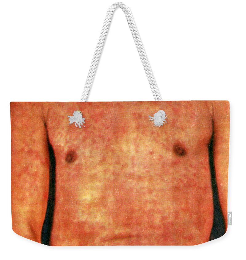 Skin Weekender Tote Bag featuring the photograph Miliaria by Science Source