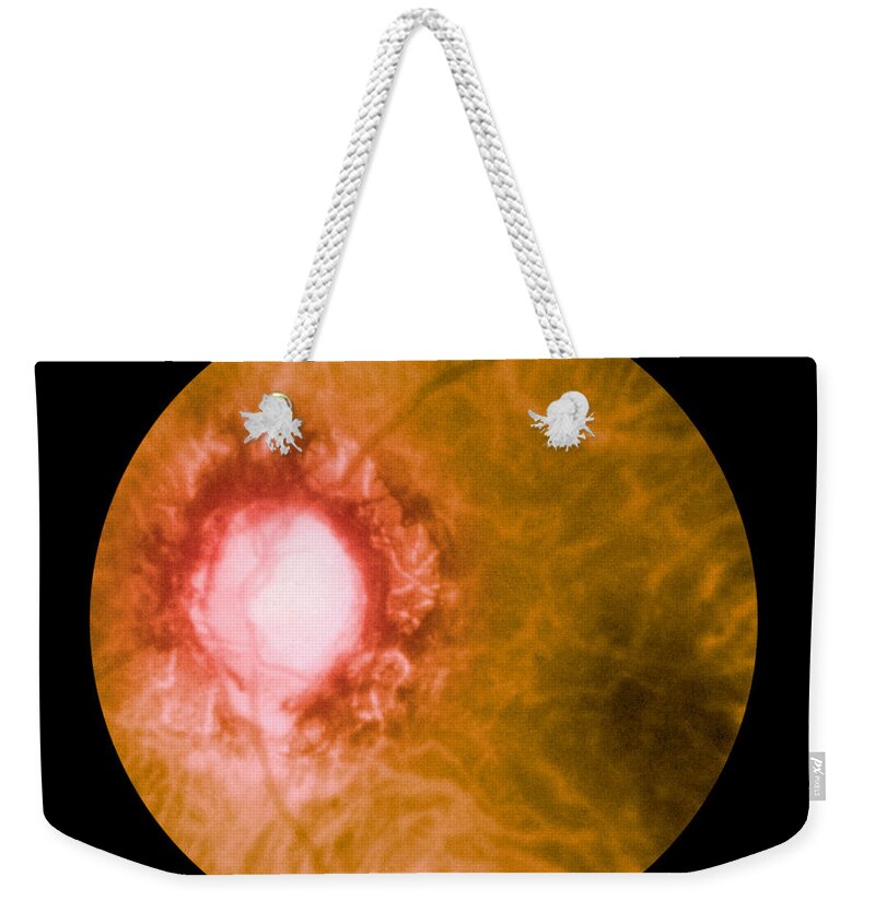 Bacteria Weekender Tote Bag featuring the photograph Retina Infected By Syphilis by Science Source