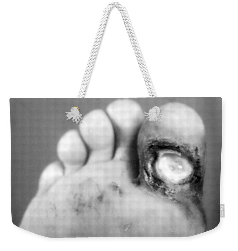 Bacterial Weekender Tote Bag featuring the photograph Syphilis Ulcer by Science Source