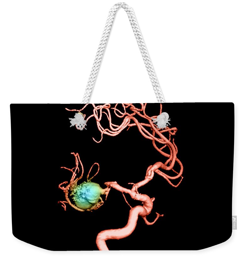 3-d Imagery Weekender Tote Bag featuring the photograph Aneurysm In The Human Brain #3 by Medical Body Scans