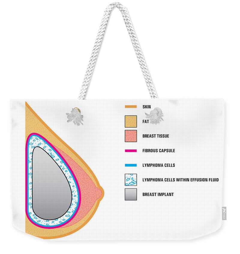 Science Weekender Tote Bag featuring the photograph Breast Implants And Cancer by Science Source