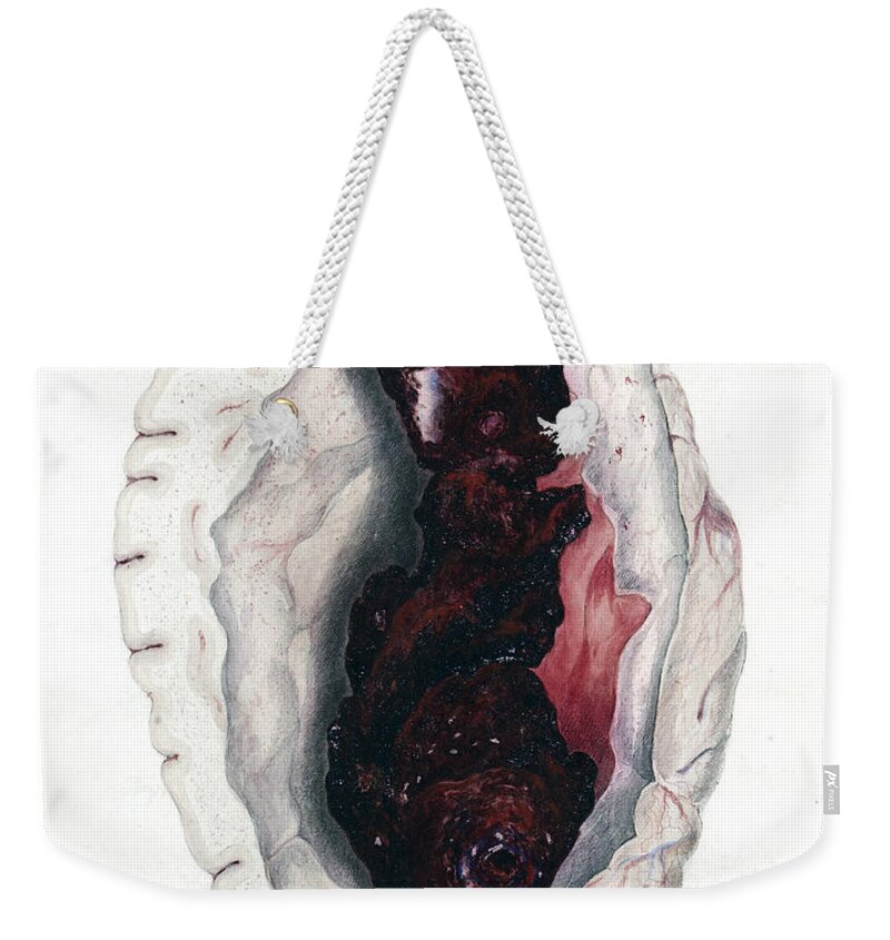 Historic Weekender Tote Bag featuring the photograph Cerebral Apoplexy, Illustration by Wellcome Images