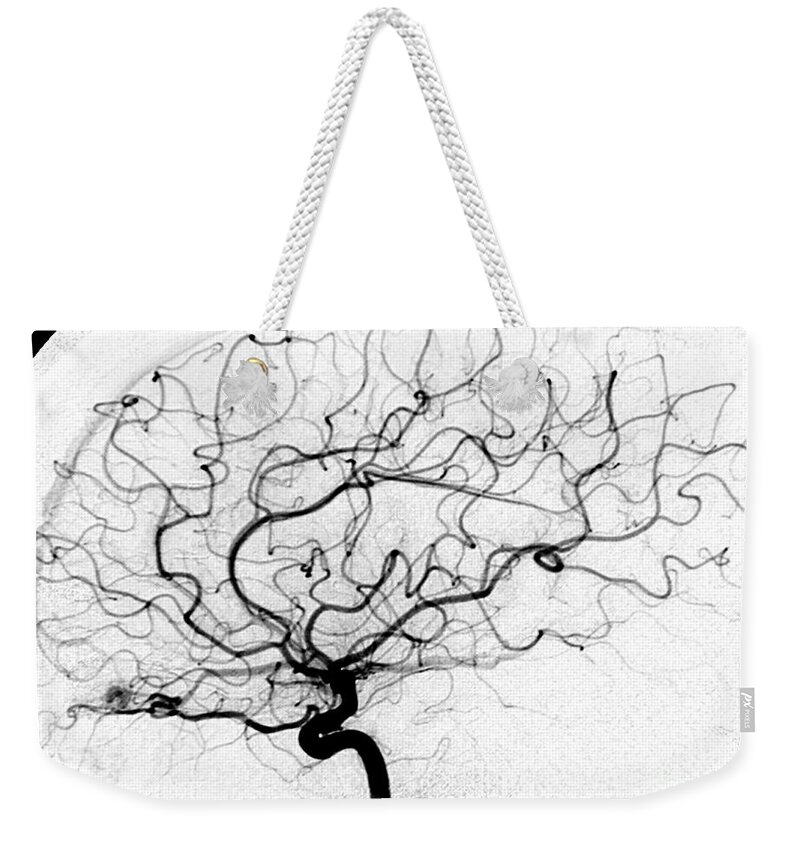 Cerebral Angiogram Weekender Tote Bag featuring the photograph Dural Arterial Venous Fistula, Angiogram by Living Art Enterprises