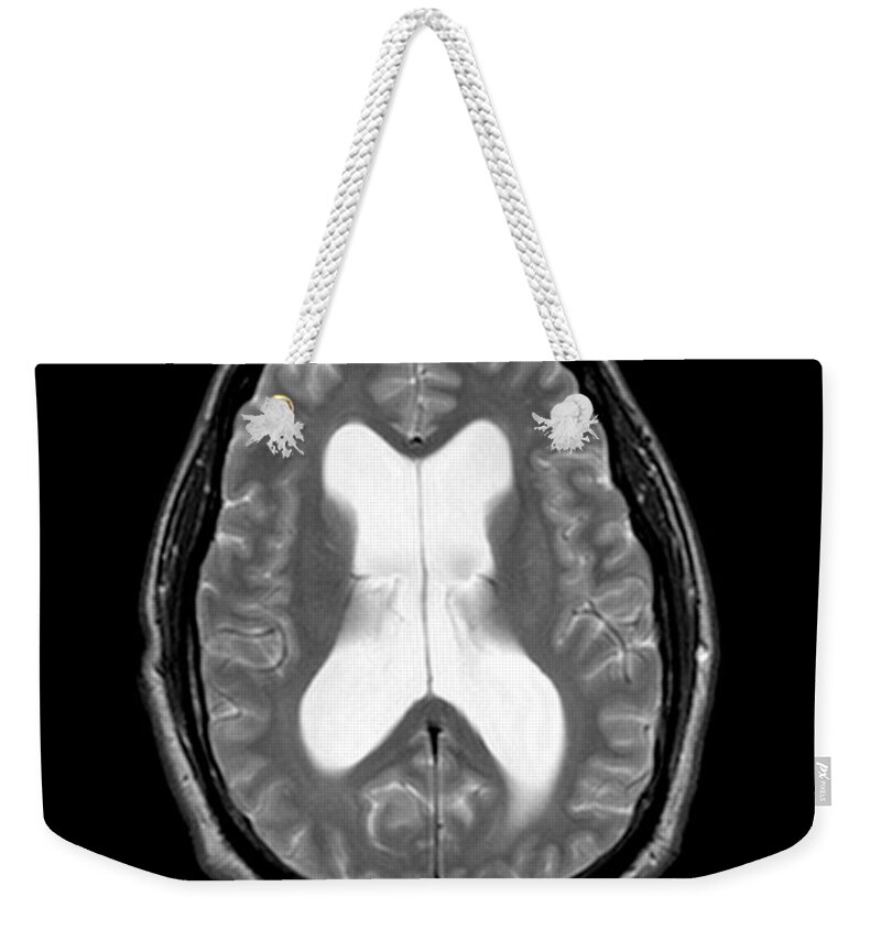 Mri Of Communicating Hydrocephalus Weekender Tote Bag featuring the photograph Mri Communicating Hydrocephalus Nph by Medical Body Scans