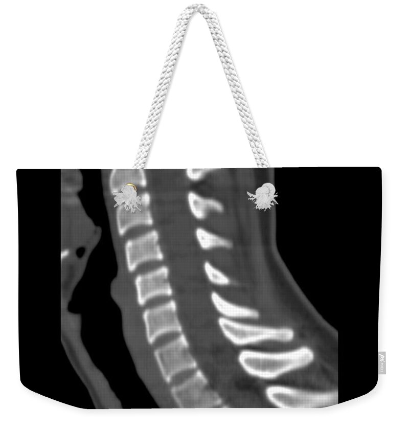 Medical Weekender Tote Bag featuring the photograph Normal Cervical Spine by Medical Body Scans