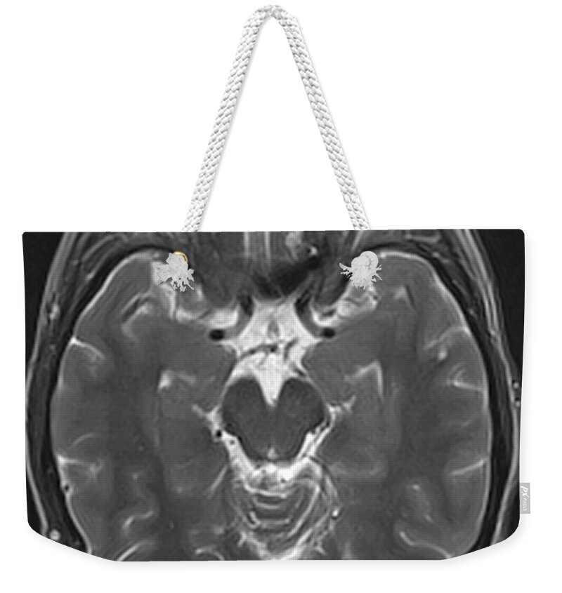 Alectinib Weekender Tote Bag featuring the photograph Brain Cancer Treated, Mri #3 by Steven Needell