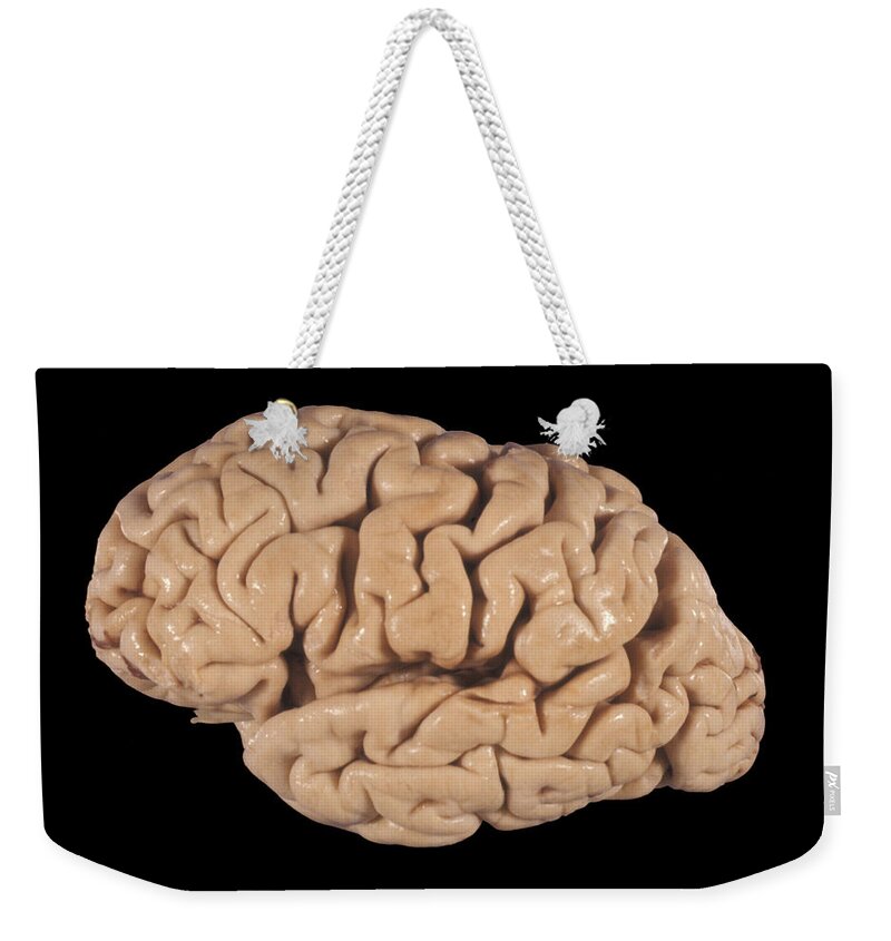 Abnormal Weekender Tote Bag featuring the photograph Human Brain, Cortical Atrophy #3 by Jose Luis Calvo