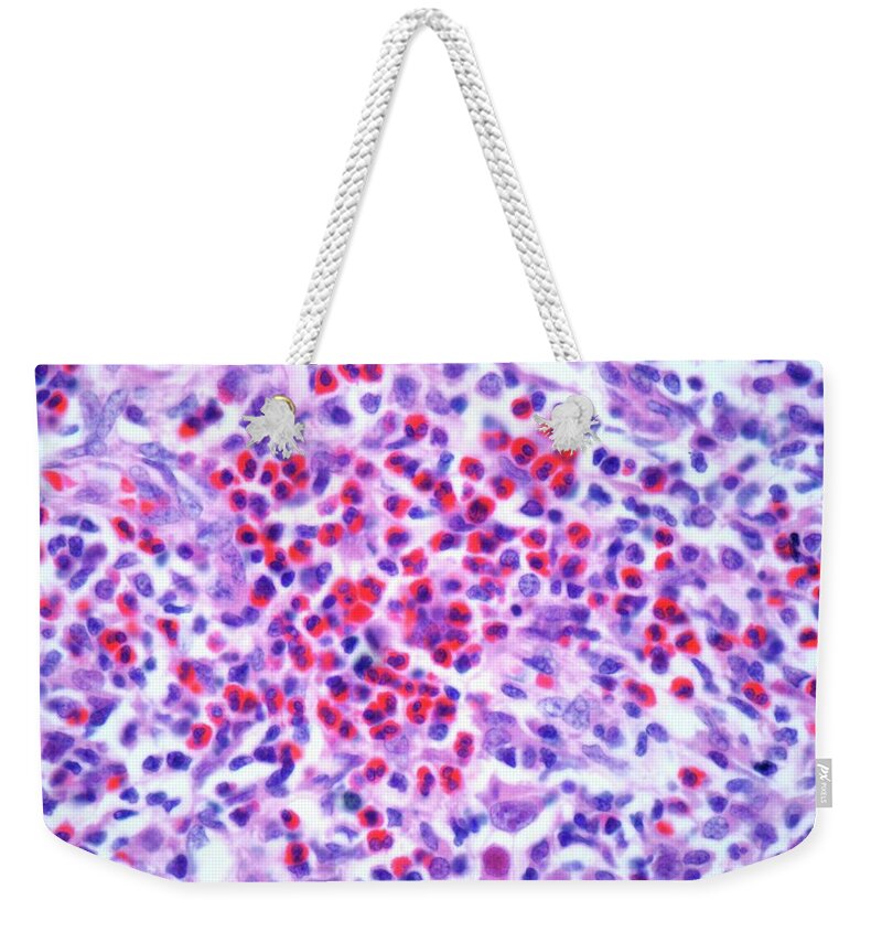 Anatomy Weekender Tote Bag featuring the digital art Hodgkins Lymphoma, Light Micrograph by Science Photo Library - Steve Gschmeissner