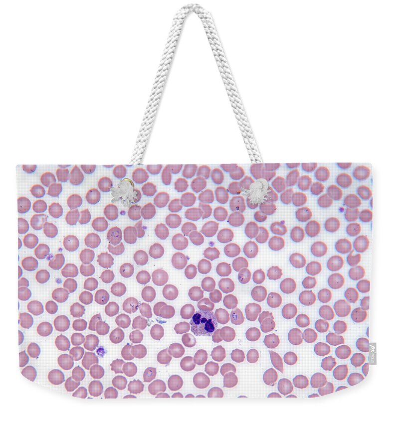 White Background Weekender Tote Bag featuring the photograph Malarial Blood Cells by michael J. Klein, M.d.