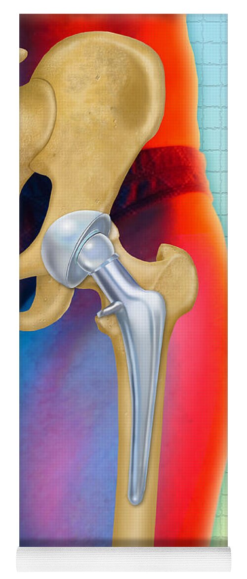 Art Yoga Mat featuring the photograph Prosthetic Hip Replacement #1 by Chris Bjornberg