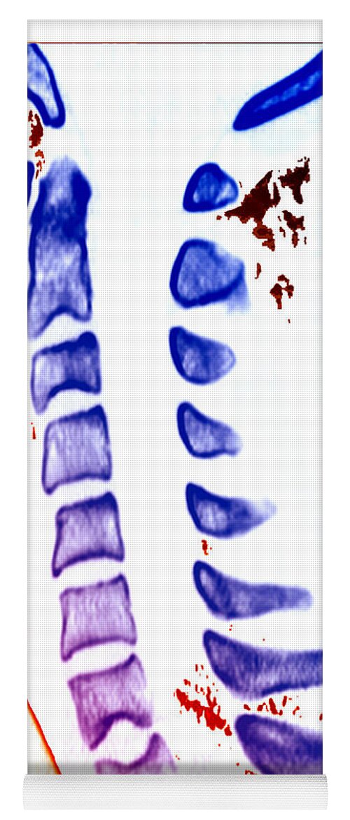Sickle Cell Anemia Yoga Mat featuring the photograph Sickle Cell Osteopathy, Ct Scan #1 by Living Art Enterprises