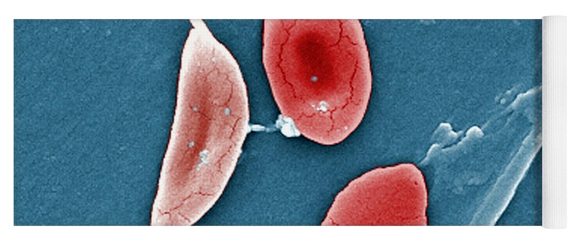 Science Yoga Mat featuring the photograph Sickle Cell Anemia, Human Rbcs, Sem #2 by Science Source