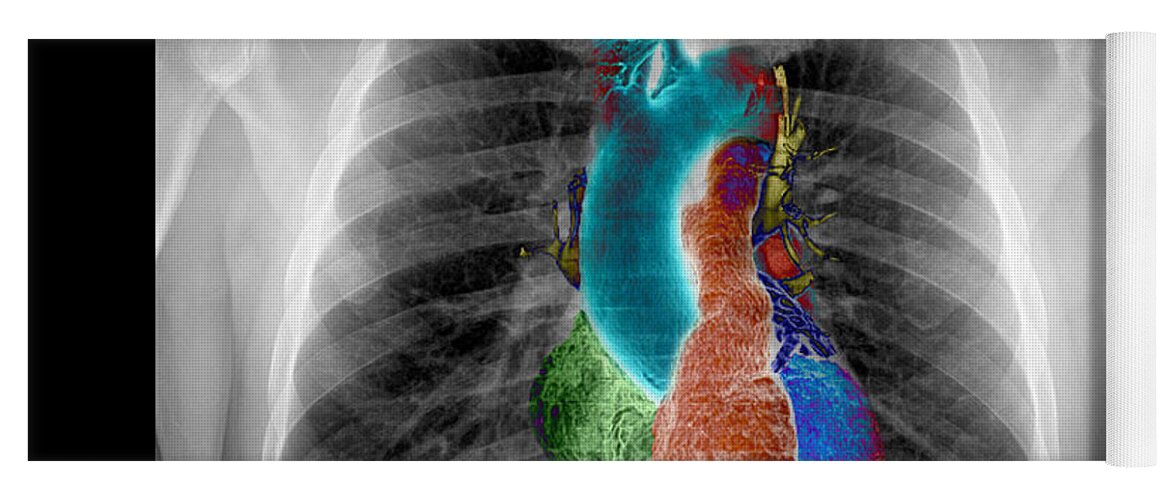 Chest Xray Yoga Mat featuring the photograph X-ray Of Chest And Heart by Living Art Enterprises