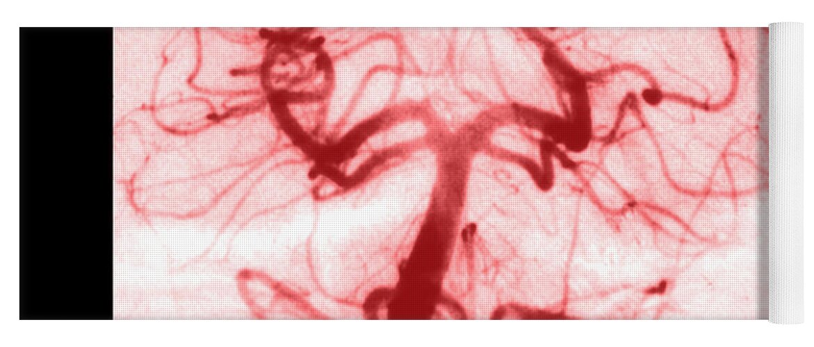 Abnormal Cerebral Angiogram Yoga Mat featuring the photograph Angiogram Of Embolus In Cerebral Artery #2 by Medical Body Scans