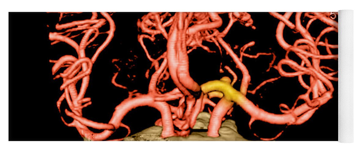 Abnormal Cerebral Blood Vessel Yoga Mat featuring the Ct Angiogram Of Aneurysm #3 by Medical Body Scans