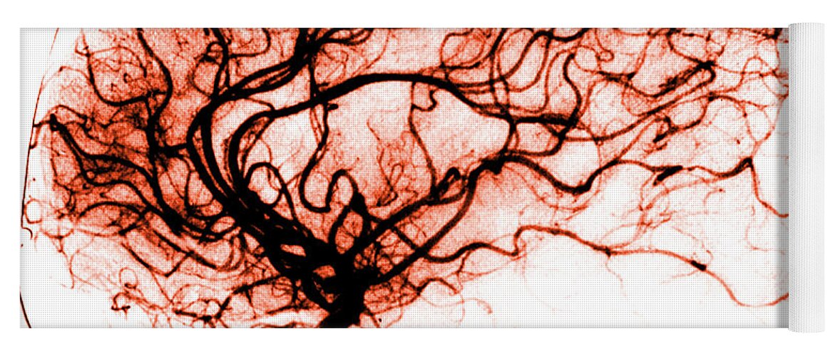 Catheter Cerebral Angiogram Yoga Mat featuring the photograph Cerebral Angiogram by Medical Body Scans
