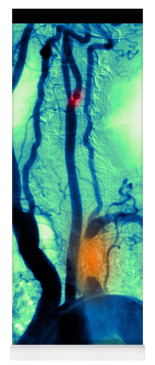 Abnormal Angiogram Yoga Mat featuring the photograph Aortic Arch Angiogram by Medical Body Scans