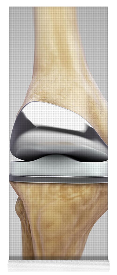 Digitally Generated Image Yoga Mat featuring the photograph Knee Replacement #2 by Science Picture Co
