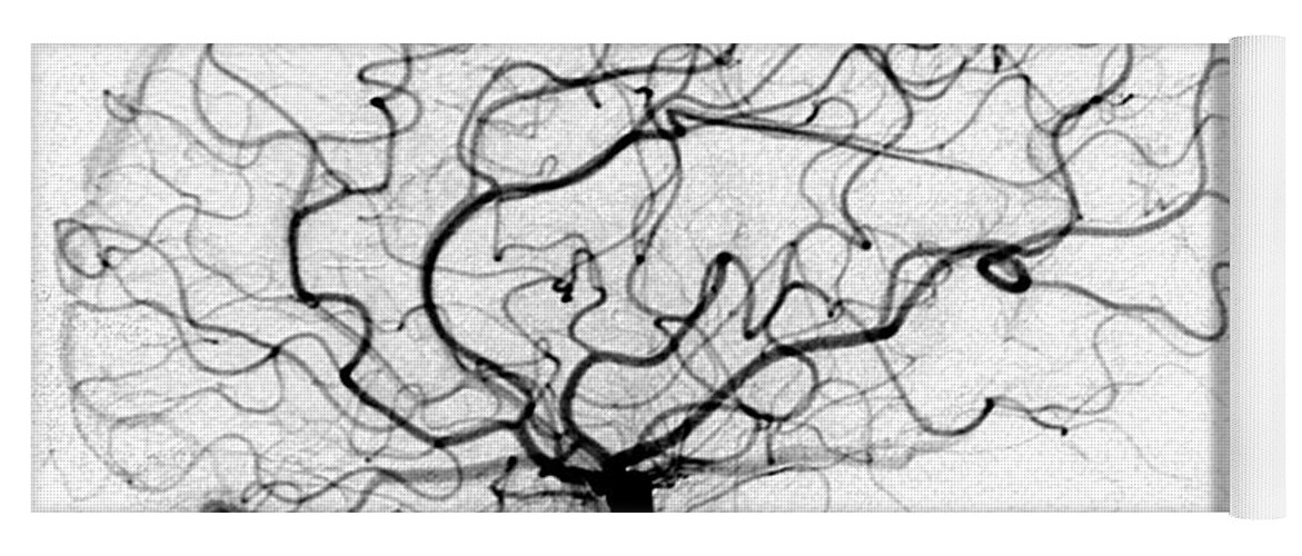 Cerebral Angiogram Yoga Mat featuring the photograph Dural Arterial Venous Fistula, Angiogram by Living Art Enterprises