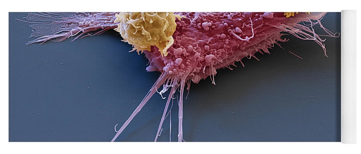 Adenocarcinoma Yoga Mat featuring the photograph Breast Cancer Cell With Car T-cells, Sem by Eye of Science