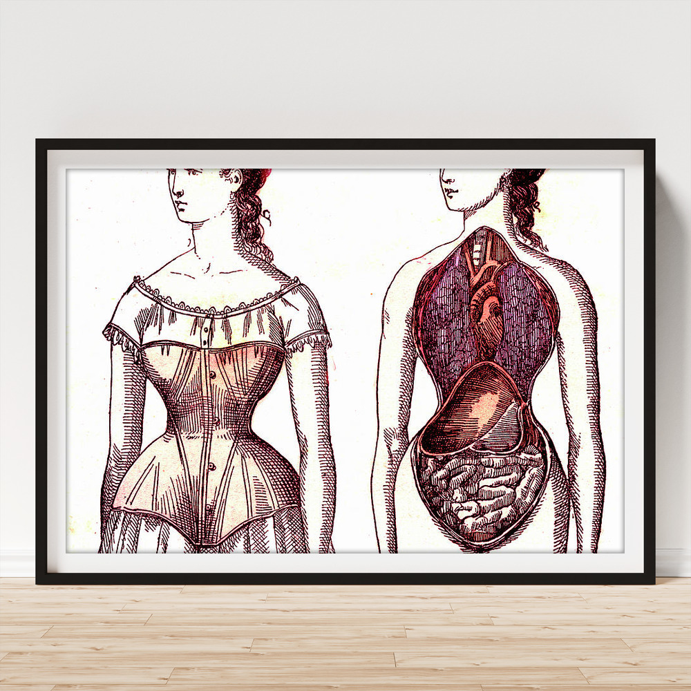 Medical Effects Of Corset Wearing Poster by Collection Abecasis/science  Photo Library