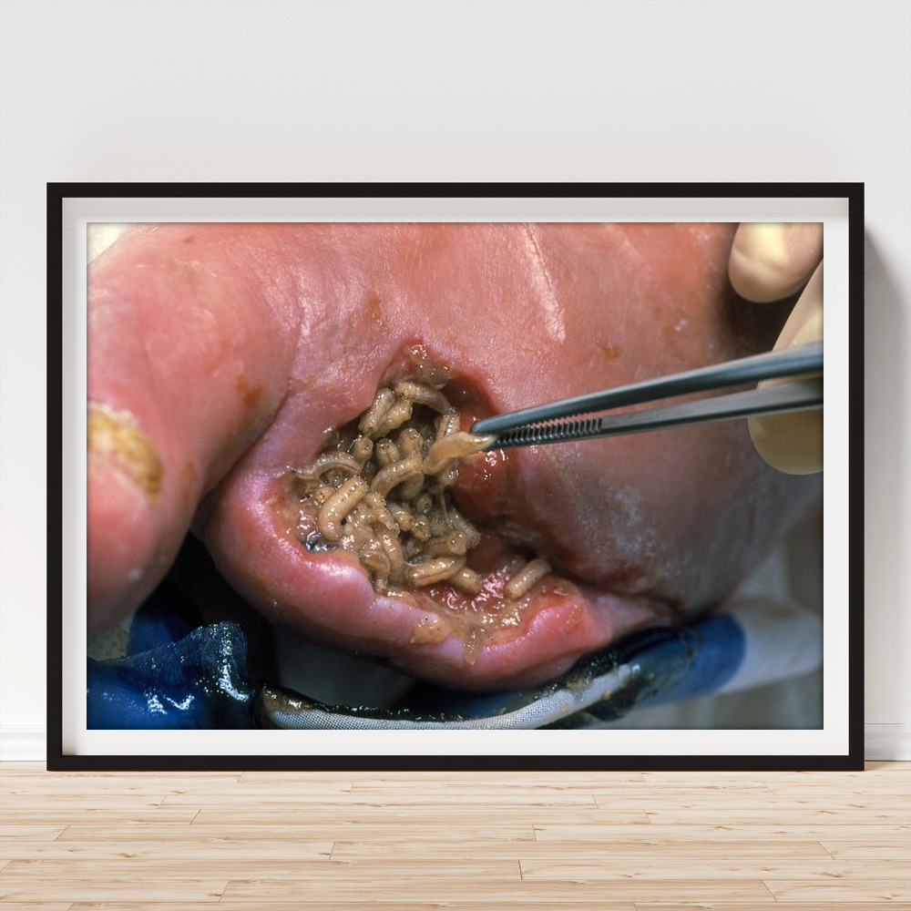 Surgeon Placing Maggots In A Wound To Clean It Art Print by Volker Steger -  Fine Art America