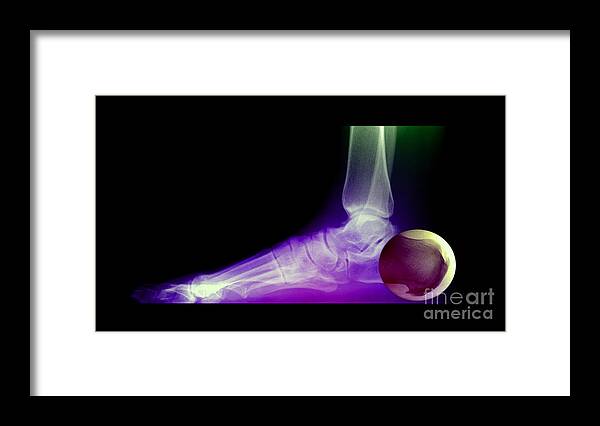 Xray Of Foot Framed Print featuring the photograph Calcaneal Spurs, X-ray #1 by Living Art Enterprises