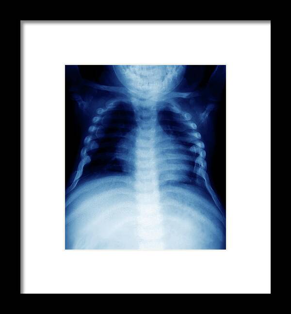 Tetralogy Of Fallot Framed Print featuring the photograph Fallot's Tetralogy #1 by Zephyr/science Photo Library