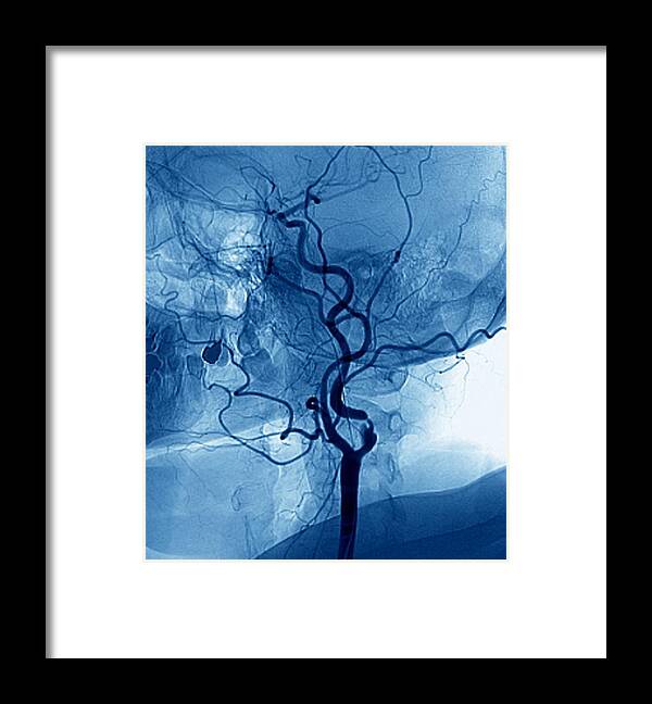 Carotid Artery Framed Print featuring the photograph Narrowed Neck Artery #1 by Zephyr/science Photo Library